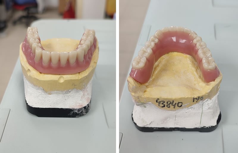 protesis dental tipo locator